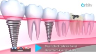 Diş implant tedavisi hangi durumlarda yapılmalıdır?