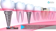 Diş implant tedavi fiyatları neden yüksektir?