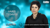 Lazerle varis tedavisi mümkün mü?