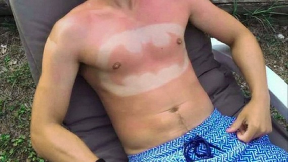 Sunburn Art