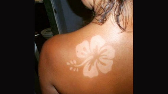 Sunburn Art