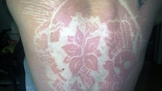 Sunburn Art