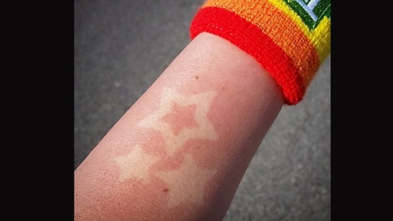 Sunburn Art