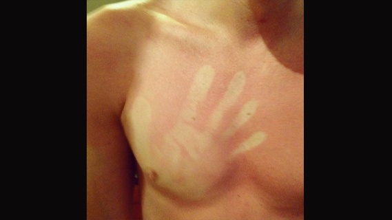 Sunburn Art