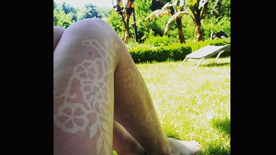 Sunburn Art