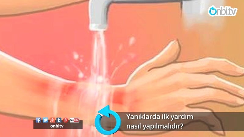 Yanıklarda ilk yardım nasıl yapılmalıdır?
