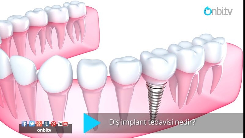 Diş implant tedavisi nedir?