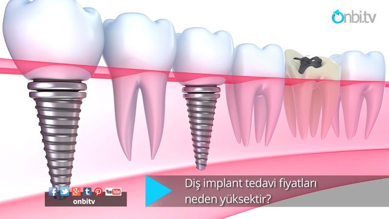 Diş implant tedavi fiyatları neden yüksektir?