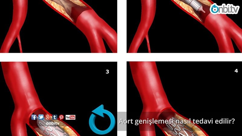 Aort genişlemesi nasıl tedavi edilir?