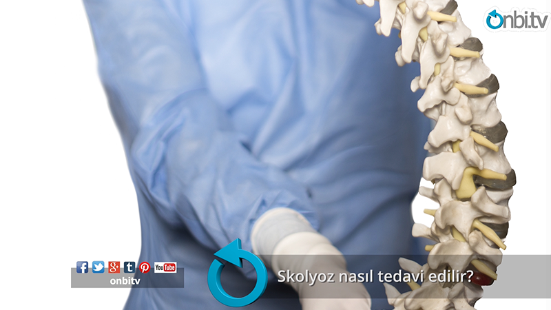 Skolyoz nasıl tedavi edilir?